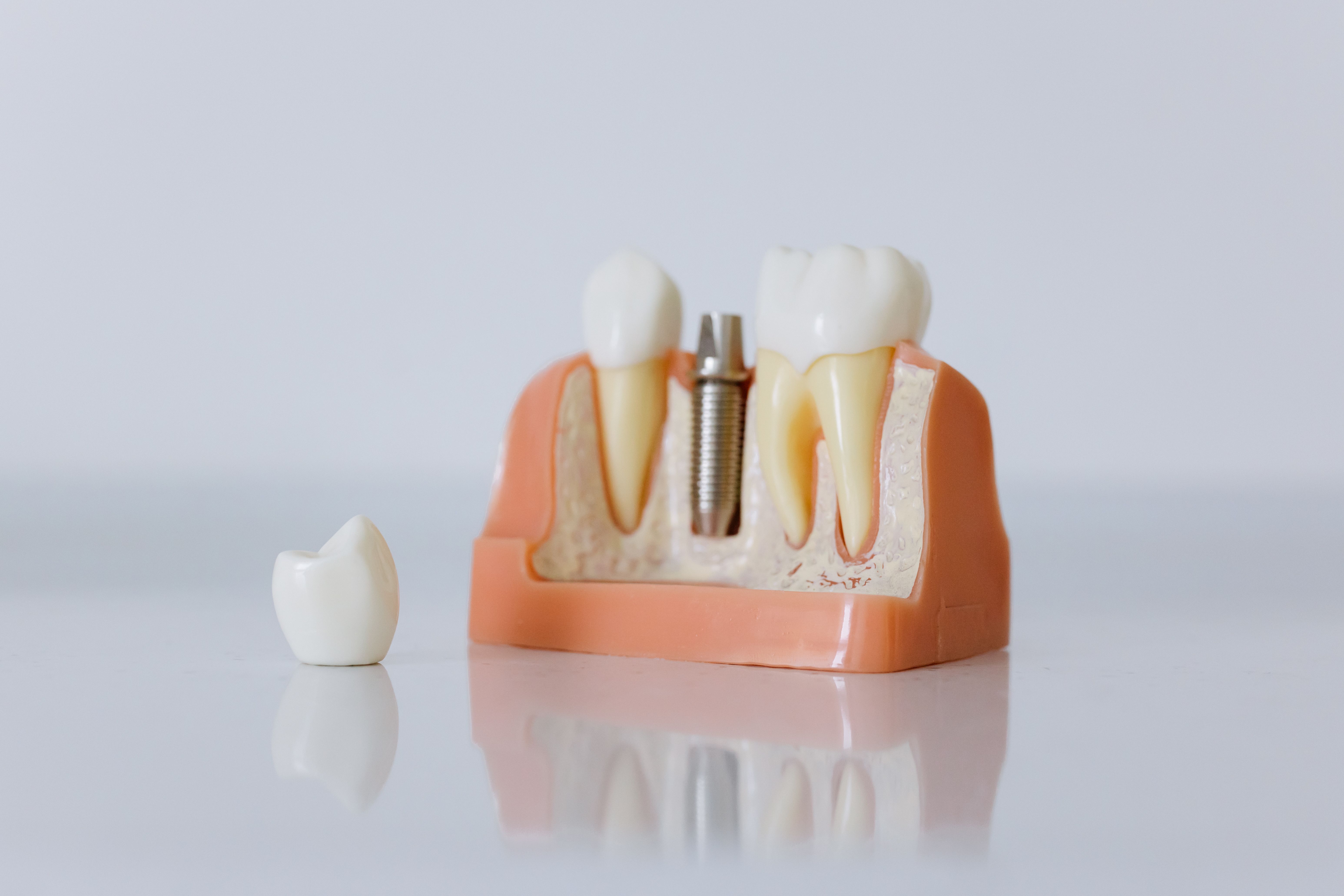 Ponerse implantes dentales en septiembre: La decisión para recuperar tu sonrisa